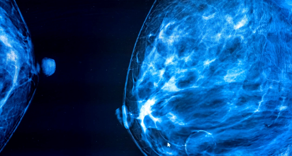 How Our Expertise in Patent Infringement Analysis Identified Diamond Patents in Mammography for Our Client